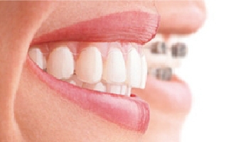 Die Zahnspange für Erwachsene – durchsichtig bis unsichtbar mit Invisalign Home 1 Invisalign unsichtbare Zahnspange laecheln Zahnarzt Köln