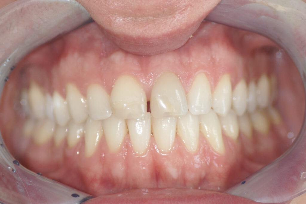 Veneers Vorher