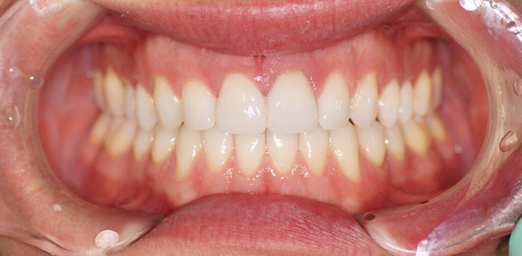 Veneers 2 Veneers nacher Zahnarzt Köln