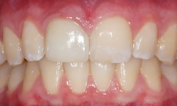 Nach der Behandlung ist der abgebrochene Zahn wieder ganz