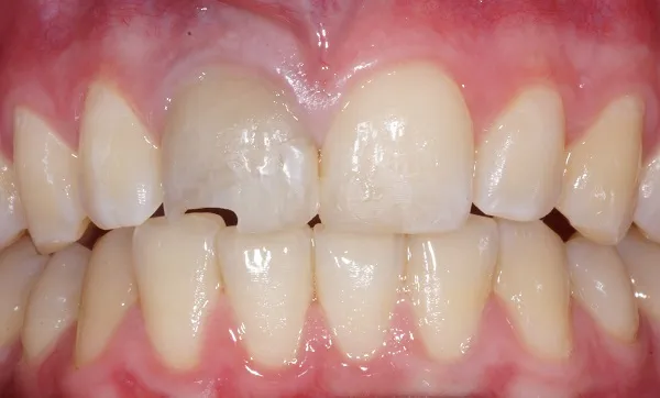 Am linken Schneidezahn ist unten ein Stück abgebrochen