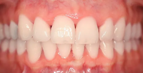 Nachherbild vom Bleaching, welches die weißen Zähne zeigt
