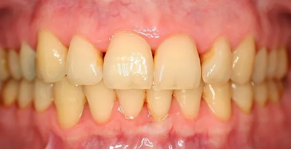 Vorherbild vom Bleaching, welches gelblich verfärbte Zähne zeigt