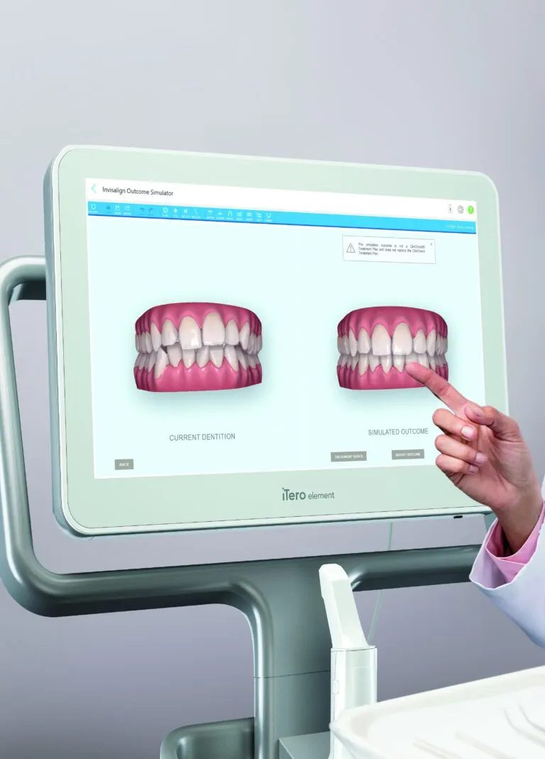 Simulator welcher zeigt, wie die Zähne nach der Invisalign-Behandlung aussehen