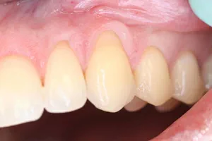 Nahaufnahme von deutlich erkennbaren freiliegenden Zahnhälsen