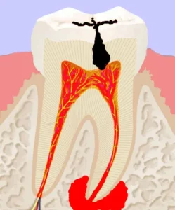 Illustration eines Querschnitts eines infizierten Zahn, der eine Wurzelkanalbehandlung benötigt
