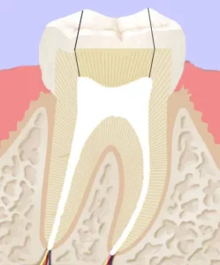 Illustration des Querschnitts eines Zahns, welcher nach der Wurzelkanalbehandlung an der Seite verschlossen wurde