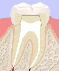 Illustration des Querschnitts eines Zahn, welcher nach einer Wurzelkanalbehandlung seitlich verschlossen wurde