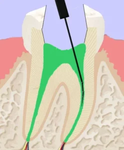 Illustration des Querschnitts eines Zahns, welcher gerade einer Wurzelkanalbehandlung bekommt
