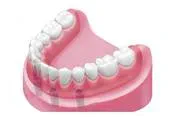 Implantatgetragene herausnehmbare Prothese