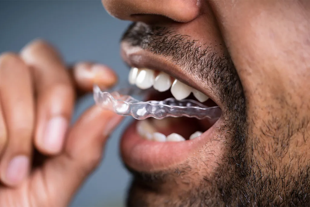 Ein Mann nimmt seine Invisalign-Schiene und steckt sie auf die Zähne