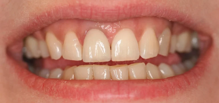 Nach dem Aufsetzen der Zahnkrone ist der schwarze Zahn wieder weiß