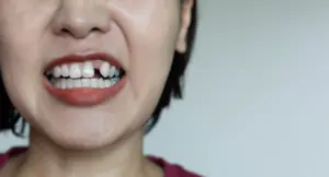 Nahaufnahme eines Kindes mit abgebrochenem oberen Frontzahn und sichtbarer Zahnlücke.