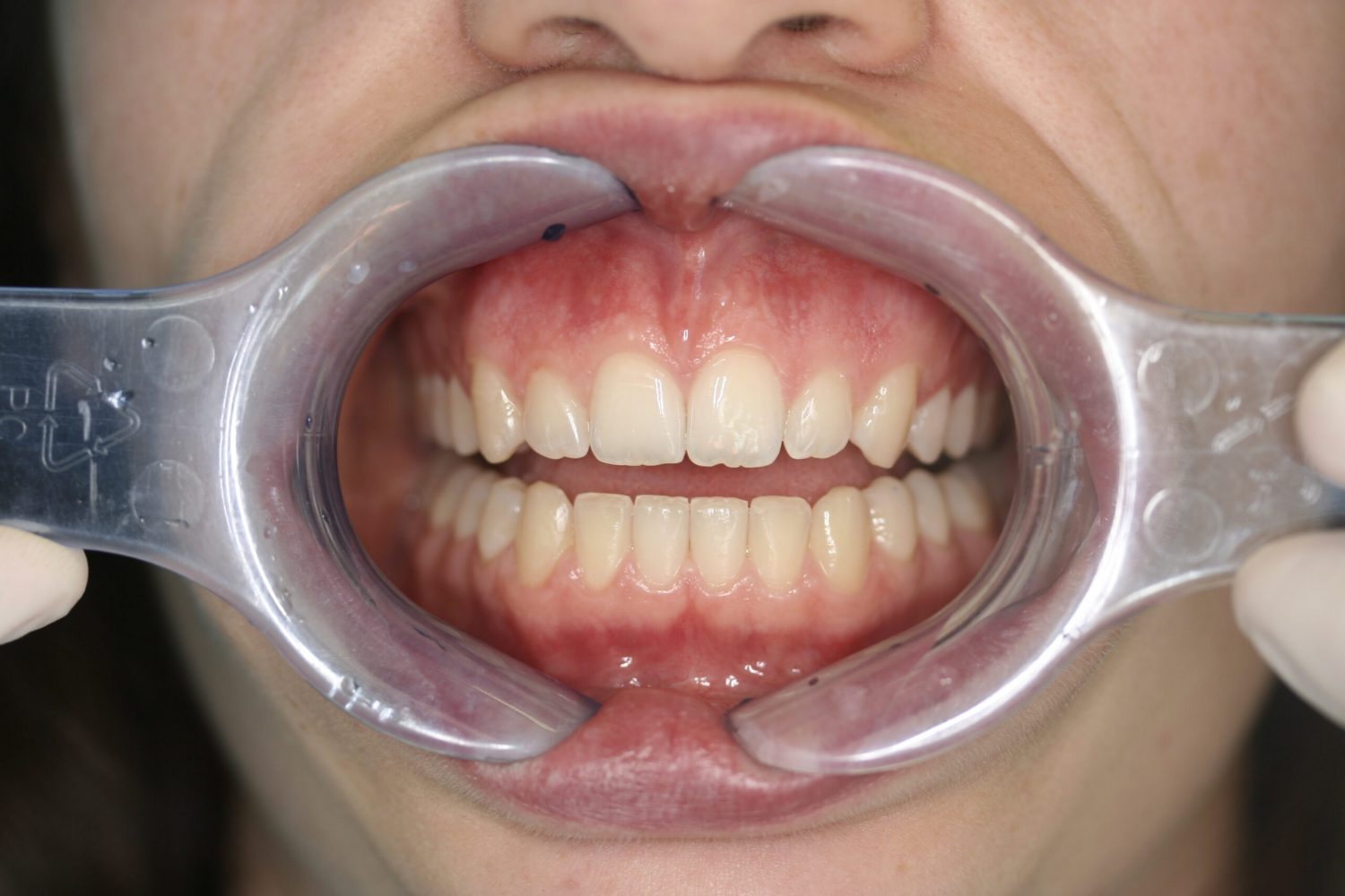 Invisalign nacher