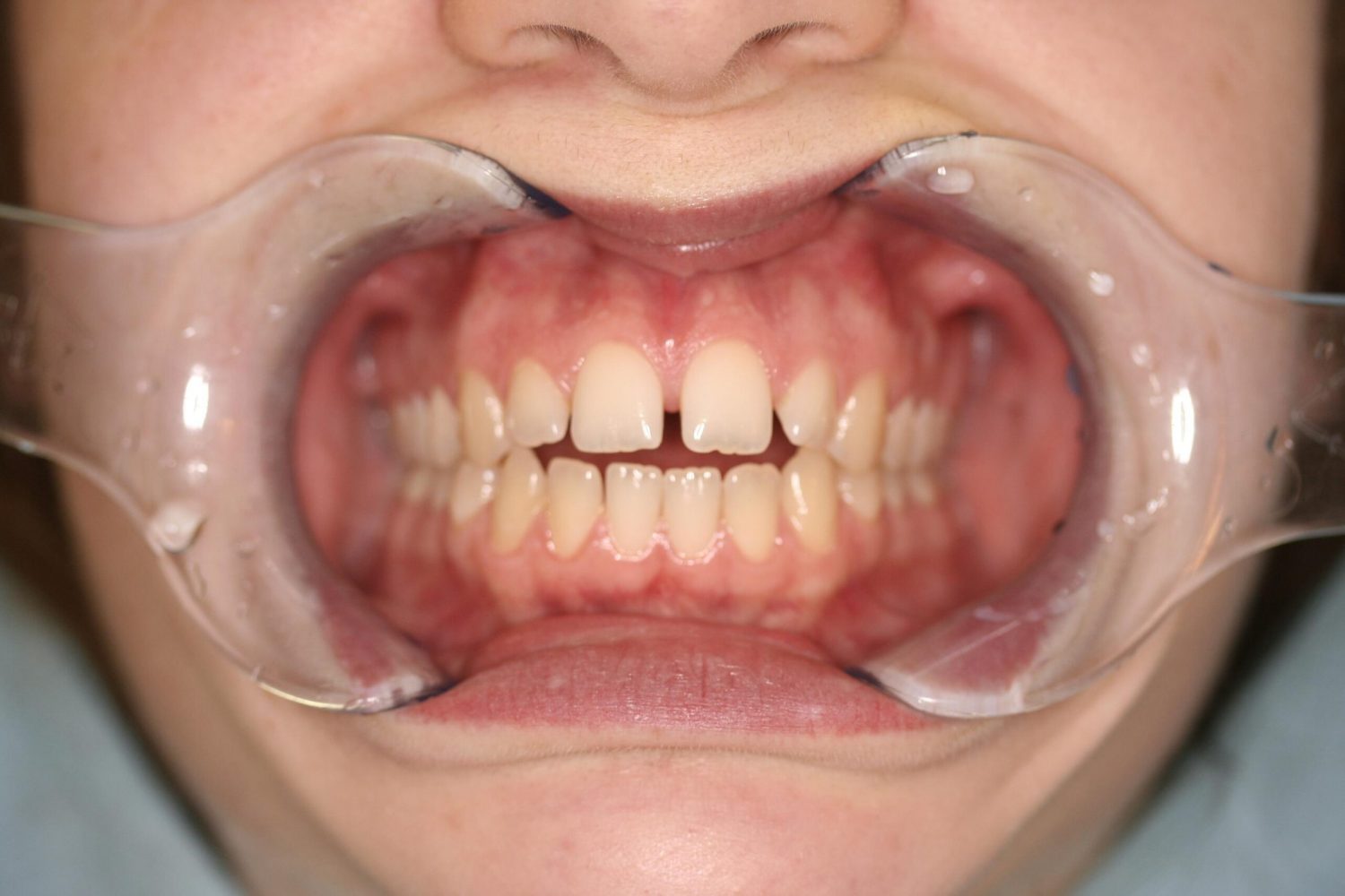 Invisalign vorher