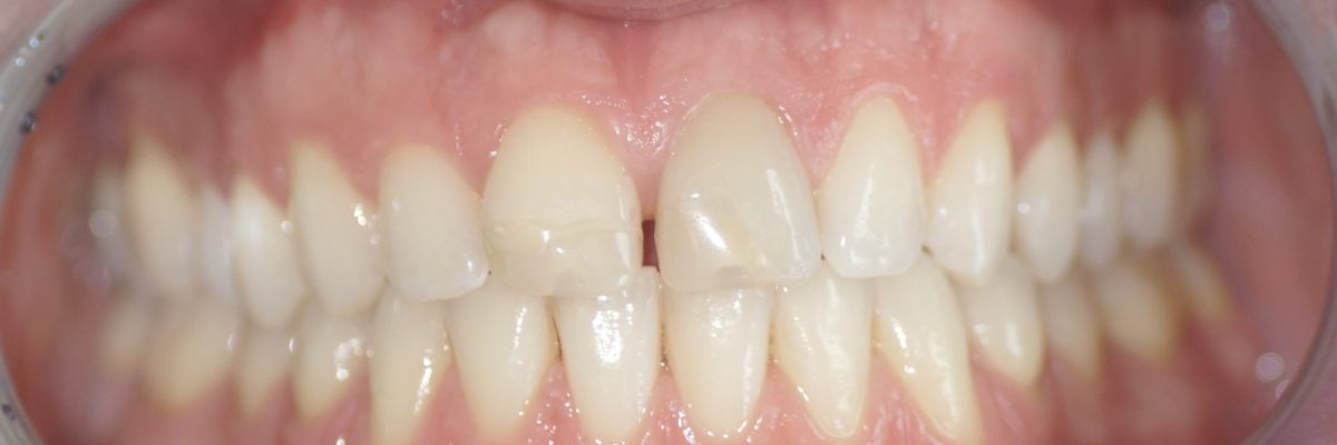 Veneers Vorher