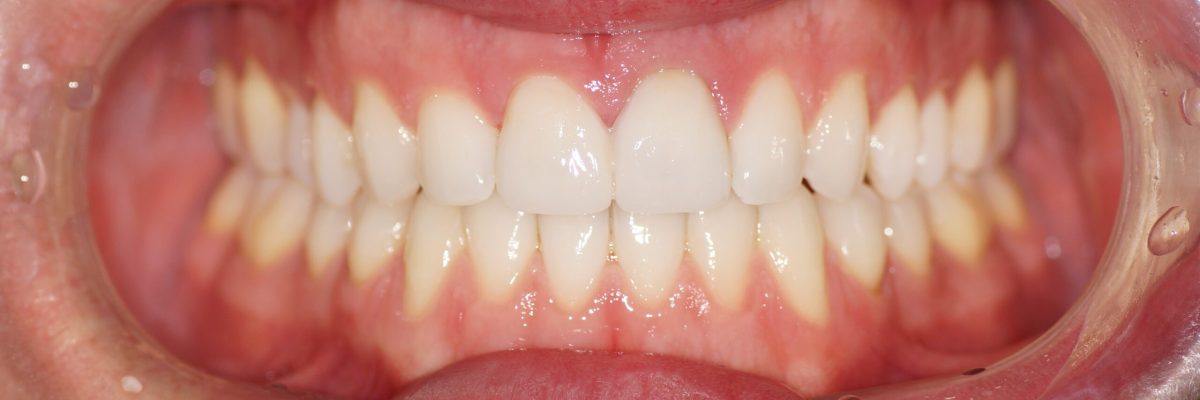 Veneers nacher