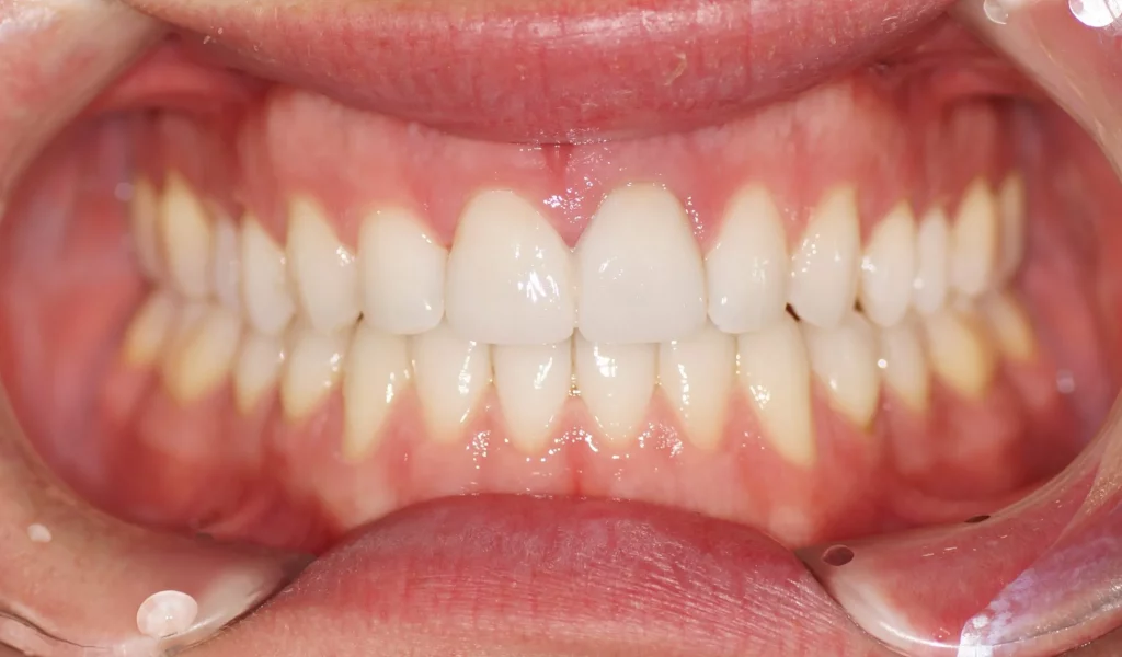 Veneers nachher Nahaufnahme von Zähnen, welche durch Invisalign wieder gerade sind