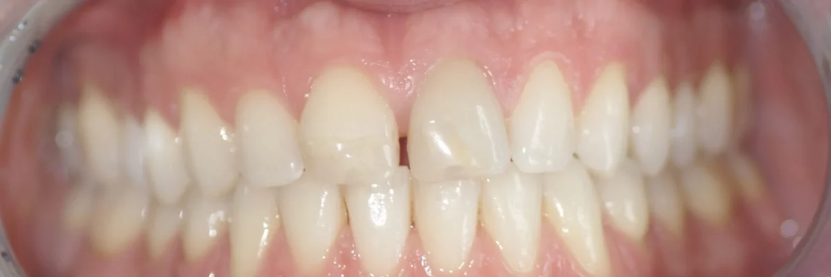 Nahaufnahme von Zähnen, welche uneben und leicht schief sind