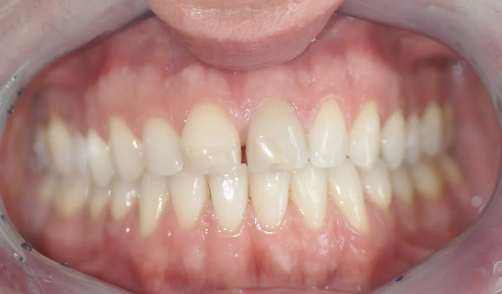 Veneers vorher Nahaufnahme von Zähnen, welche uneben und leicht schief sind